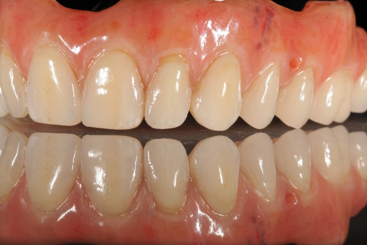 prothese-adjointe-paris (5)